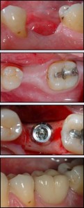Implante Dental Primer Molar